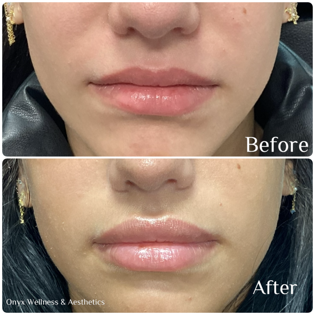 Comparison of lips before and after treatment, showing fuller and glossier appearance in the after image.
