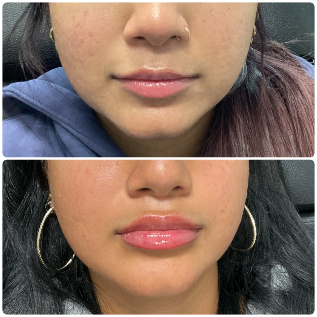 Comparison of two close-up images of lips, showing different lip colors and styles. The top image features natural lips, while the bottom shows glossy lips with hoop earrings.