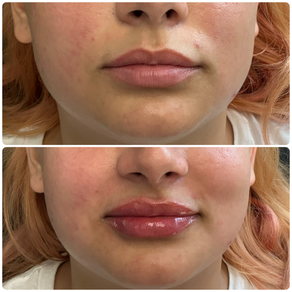 Before and after images of a woman's lips showing a natural matte finish and a glossy, fuller appearance.