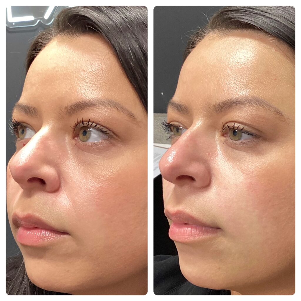 Split image of a woman's face before and after treatment. Left side shows uneven skin texture; right side is smoother and more radiant, conveying satisfaction.
