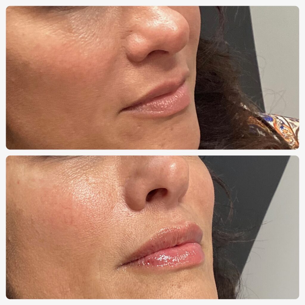 Close-up comparison of a woman's lips before and after a glossy lip enhancement treatment.