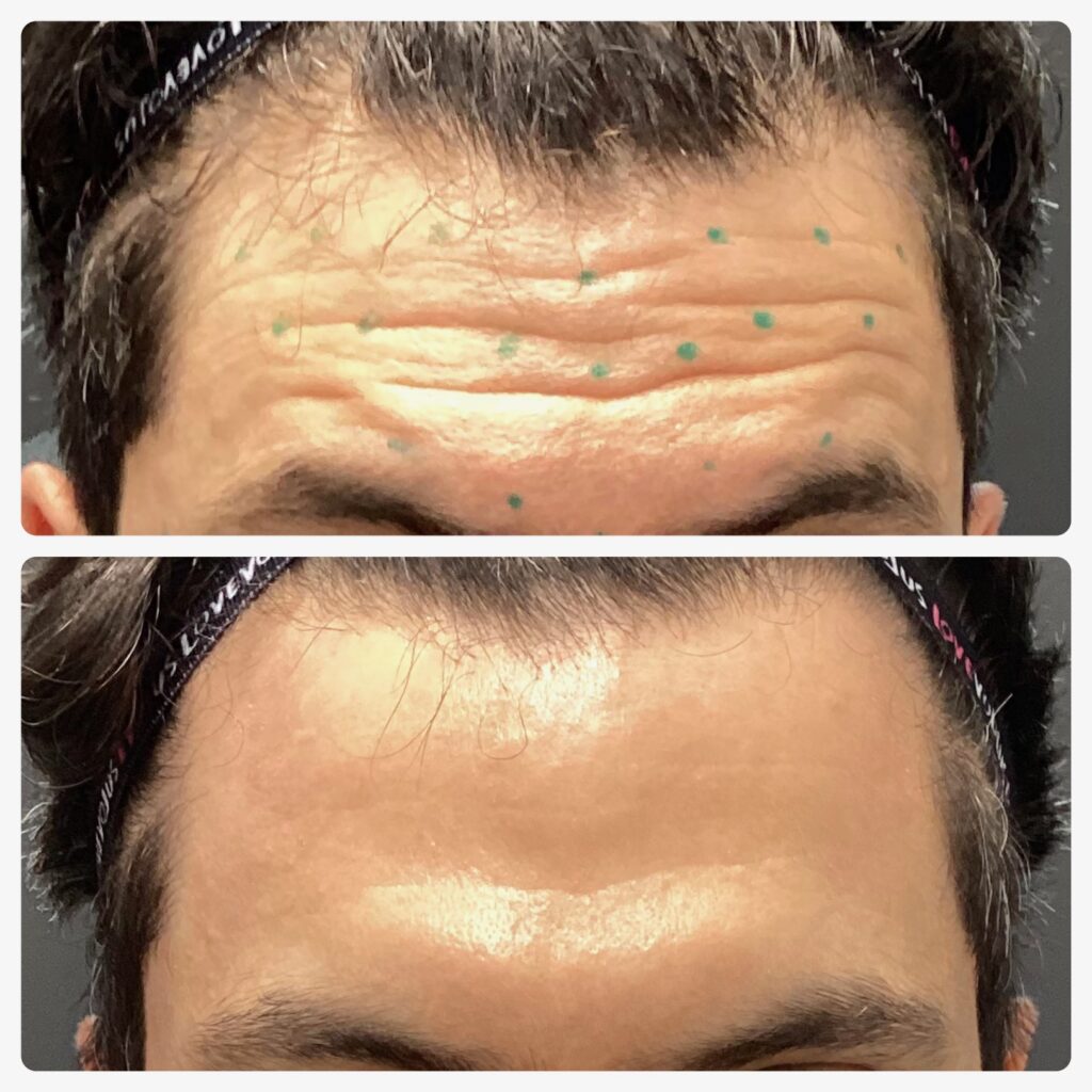 Before and after images showing a man's forehead with wrinkles and green marking dots, then smoothed skin post-treatment.
