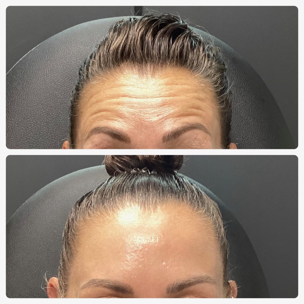 Before and after close-up images of a woman’s forehead showing reduced wrinkles and smoother skin.