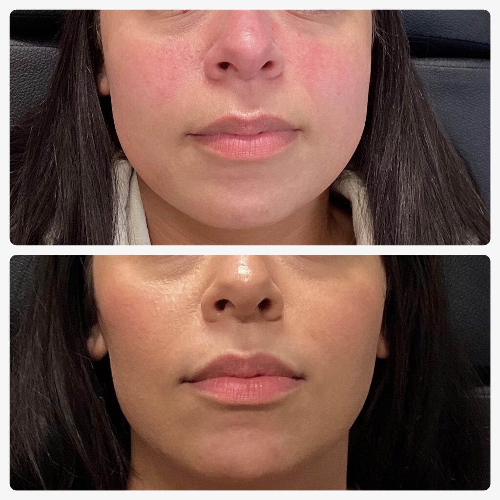 Before and after close-up photos of a woman's lower face showing reduced redness and smoother skin tone.