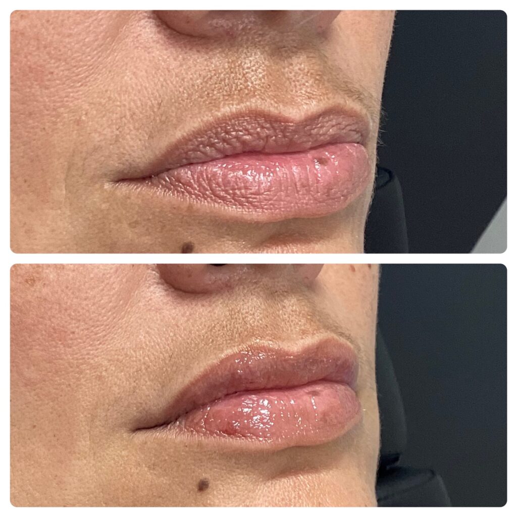 Close-up side view of lips before and after a glossy lip enhancement or treatment.