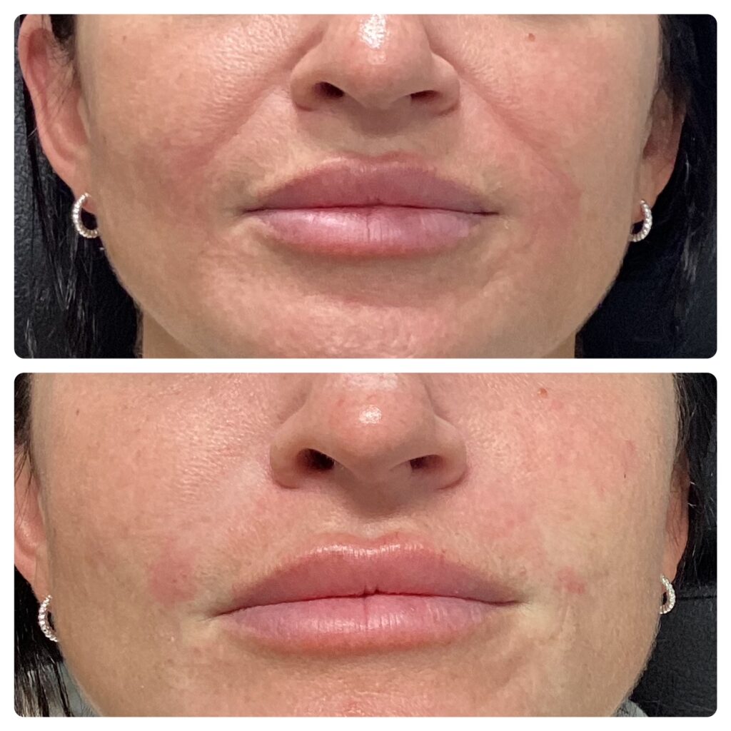 Close-up before and after images of a woman's lower face and lips showing subtle changes in lip fullness and skin texture.
